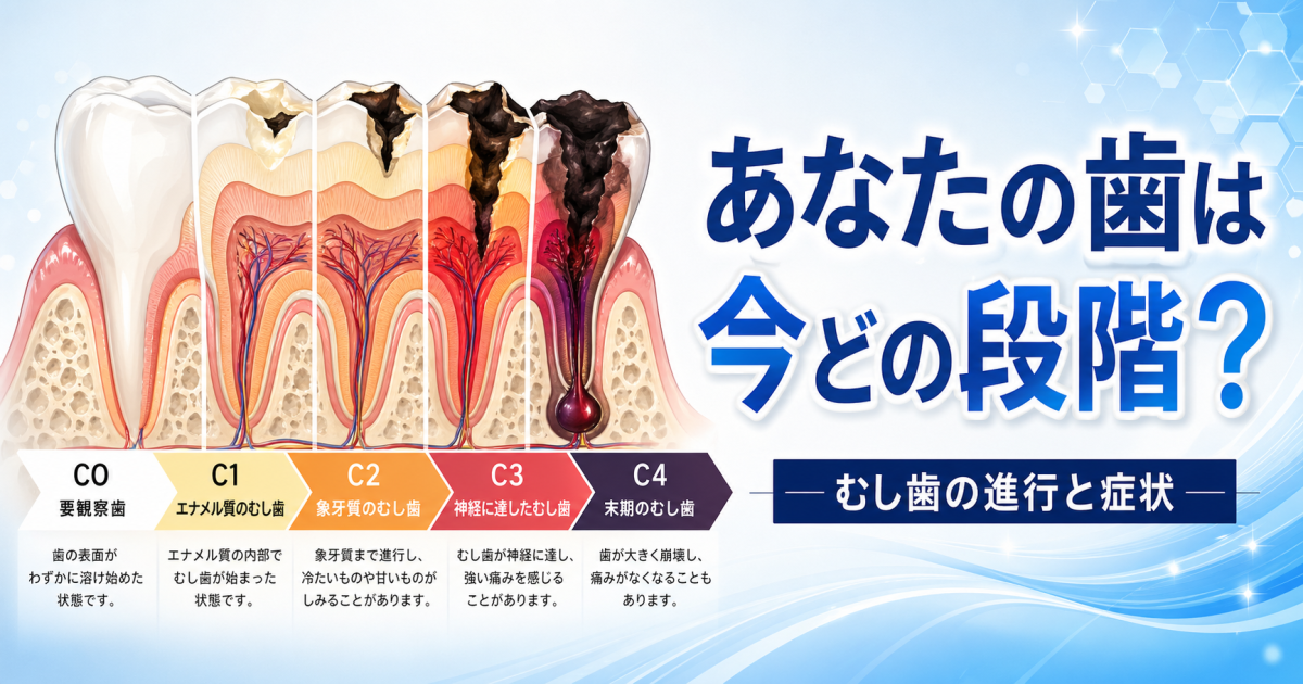 むし歯はどこまで進行すると抜歯になる？　症状から見るむし歯の段階