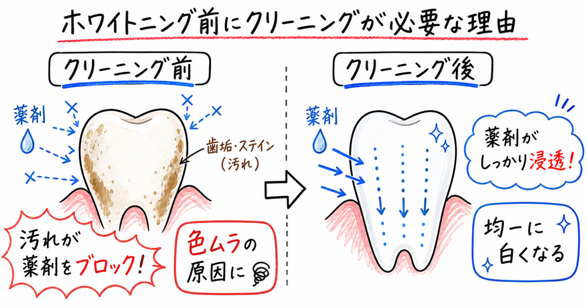 ■ホワイトニング前にクリーニングが必要な理由