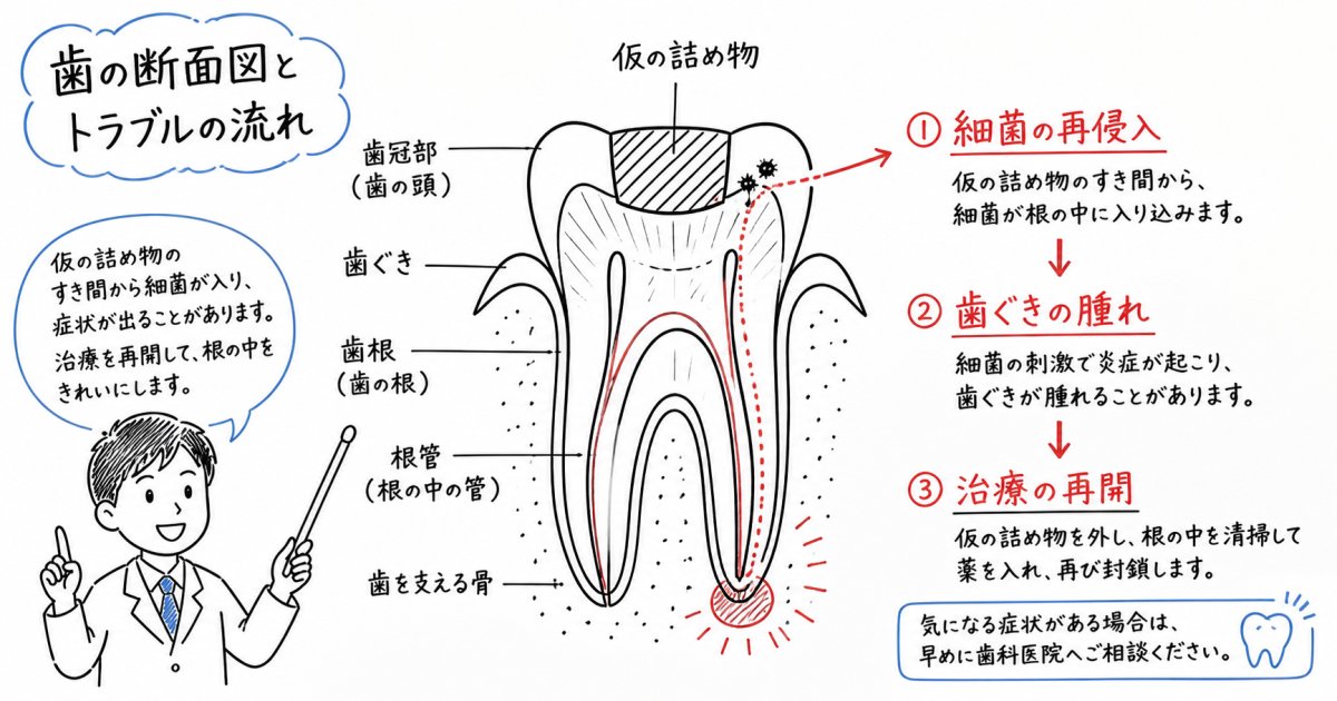 歯の根の治療を途中でやめるリスクとは？放置後の腫れや再開手順