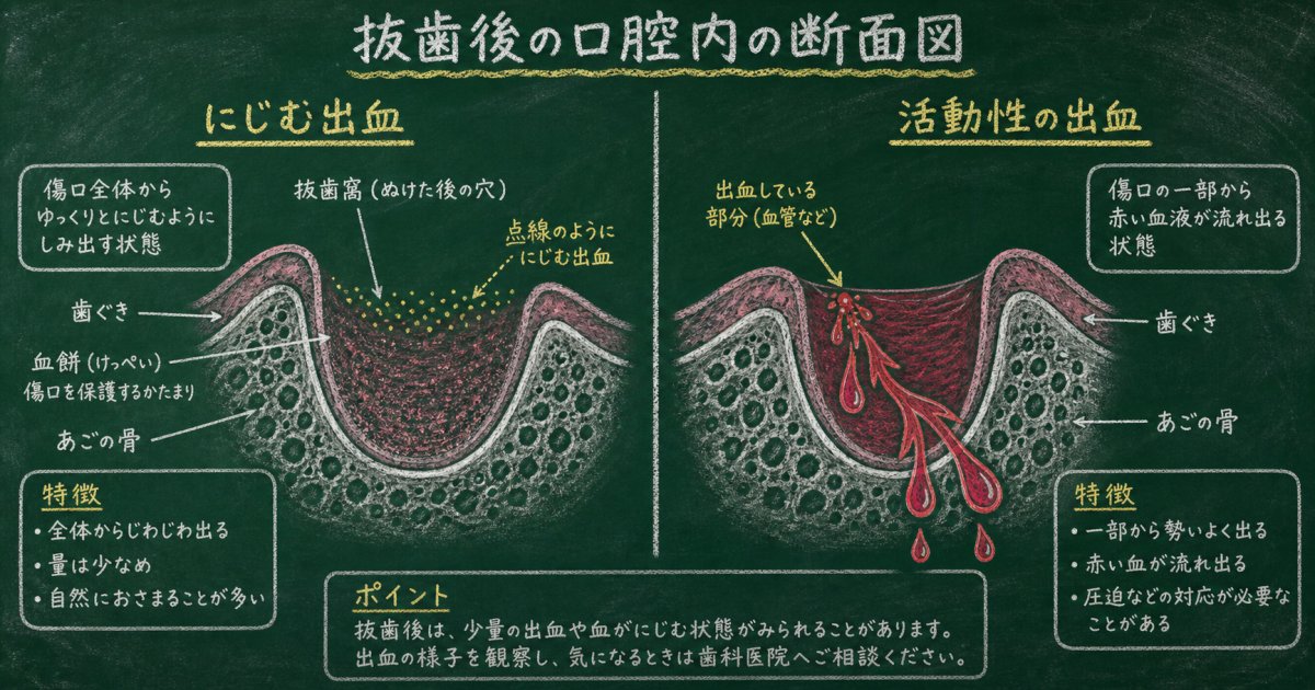 抜歯後の出血はどこまでが正常?異常な出血との見分け方